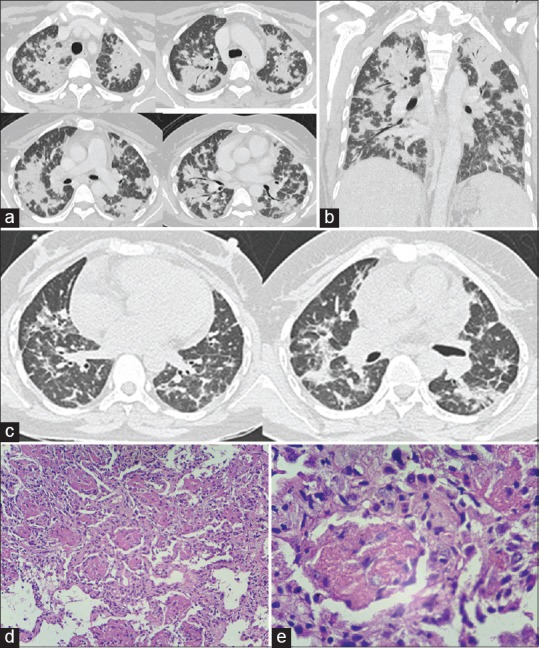 Acute fibrinous and organizing pneumonia: A rare form of nonbacterial ...