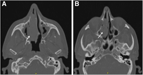 Strategy for the treatment and follow-up of sinonasal solitary ...