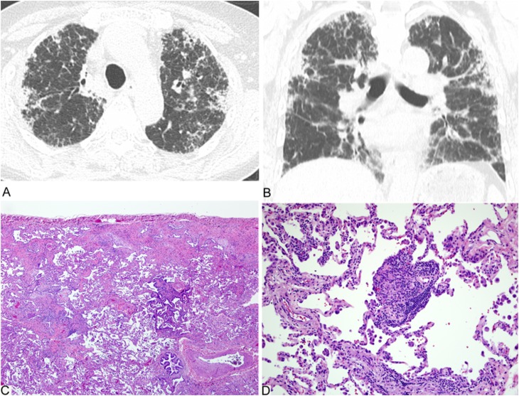 An official American Thoracic Society/European Respiratory Society ...