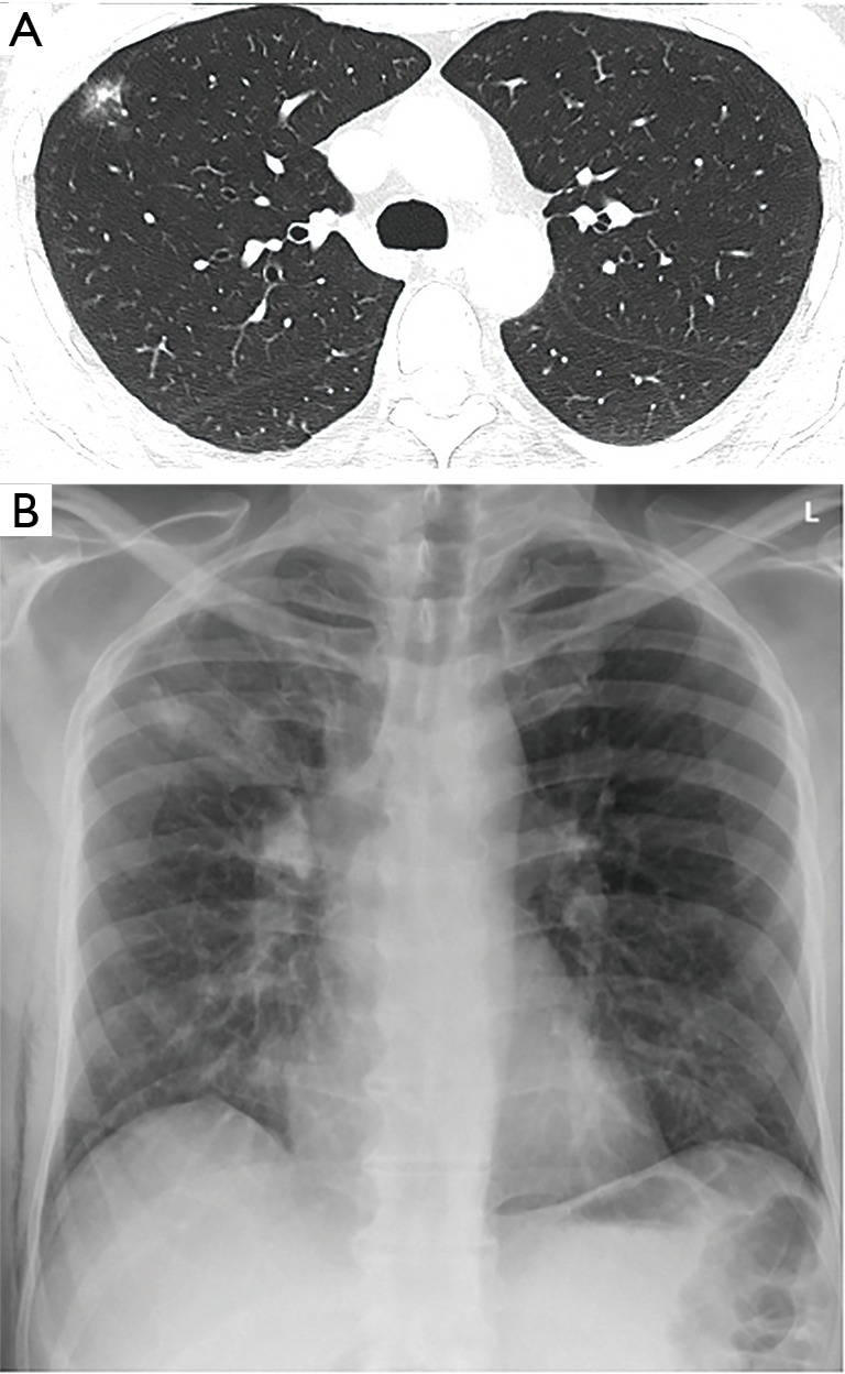 Upper lobe anterior segment (S3): technique of fissureless uniportal ... image.