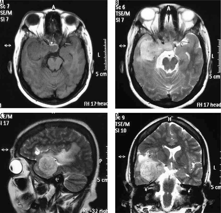 Imaging spectrum of meningiomas: a review of uncommon imaging ...