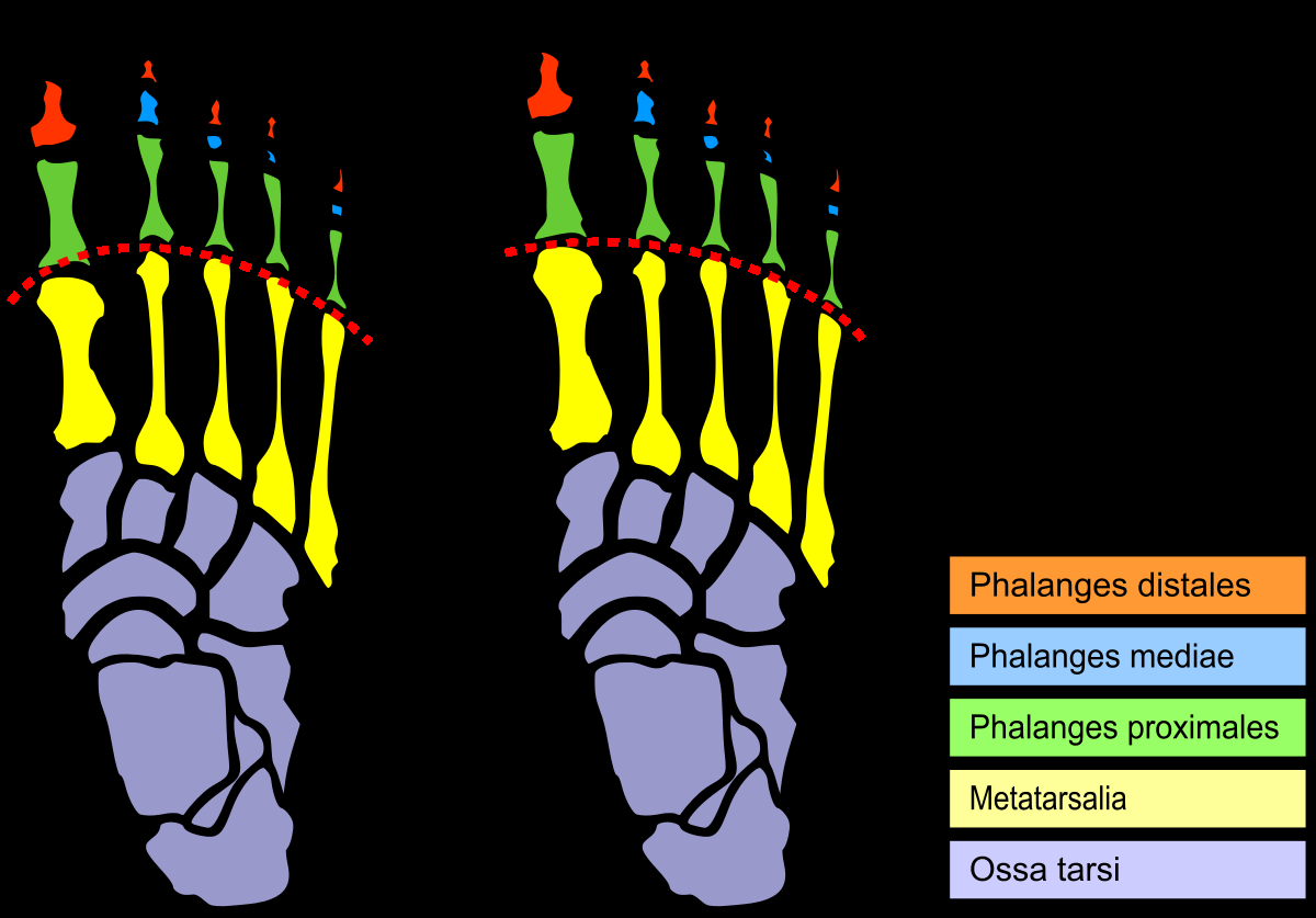 Foot Pain Diagram Mortons Toe Wikipedia