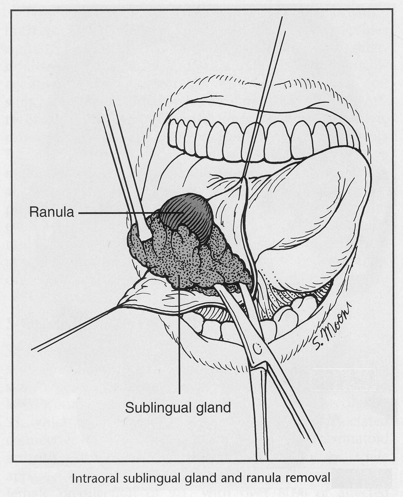 Sublingual_Gland_Removal_Ranula_Excision