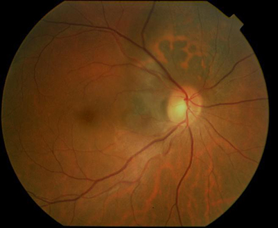 Choroidal Melanoma Affecting the Optic Nerve » New York Eye Cancer Center