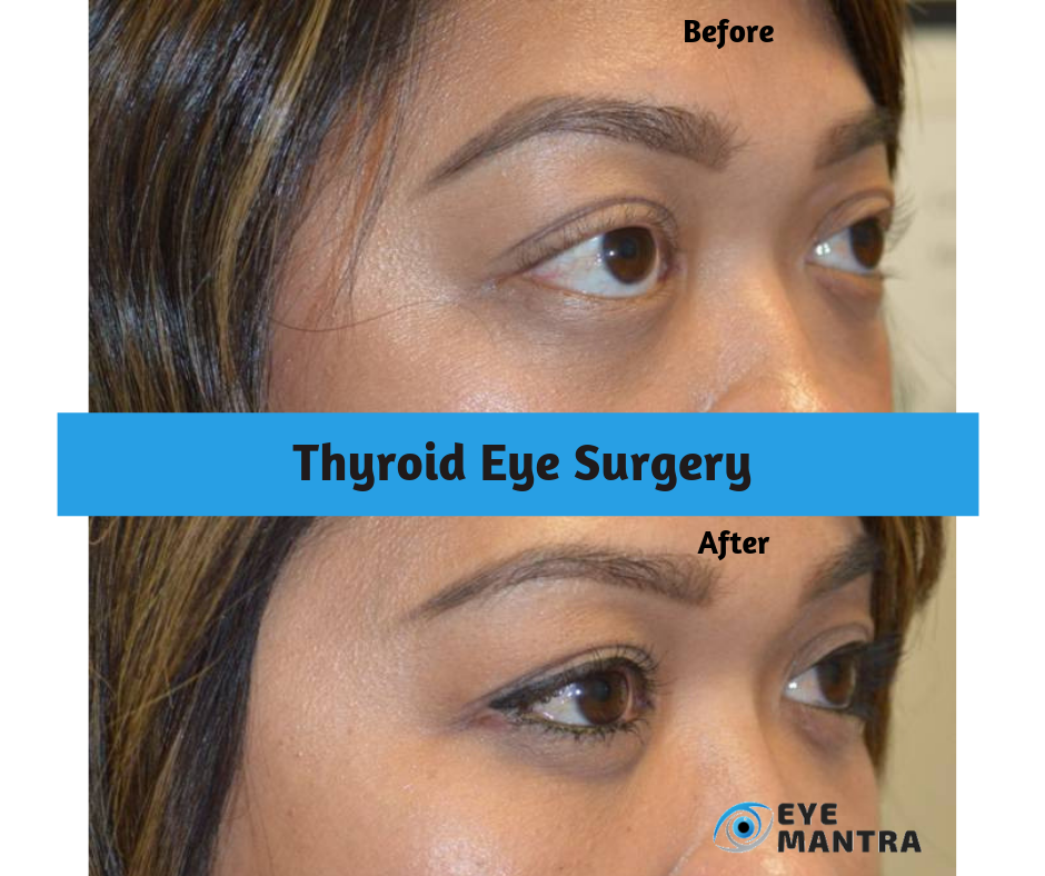 thyroid eye disease