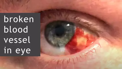 Broken Blood Vessels in Eyes