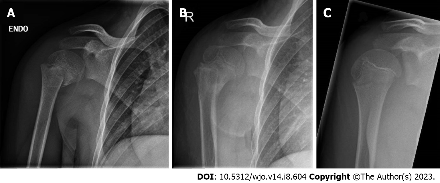 Fractures around the shoulder in the skeletally immature: A scoping review