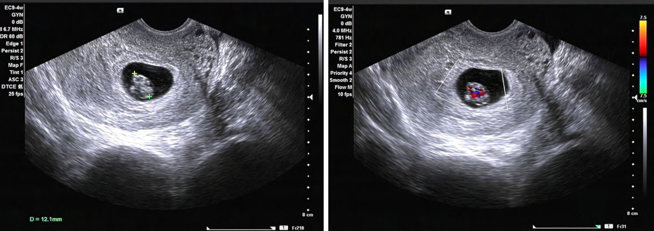 10 Weeks Pregnant Ultrasound Twins