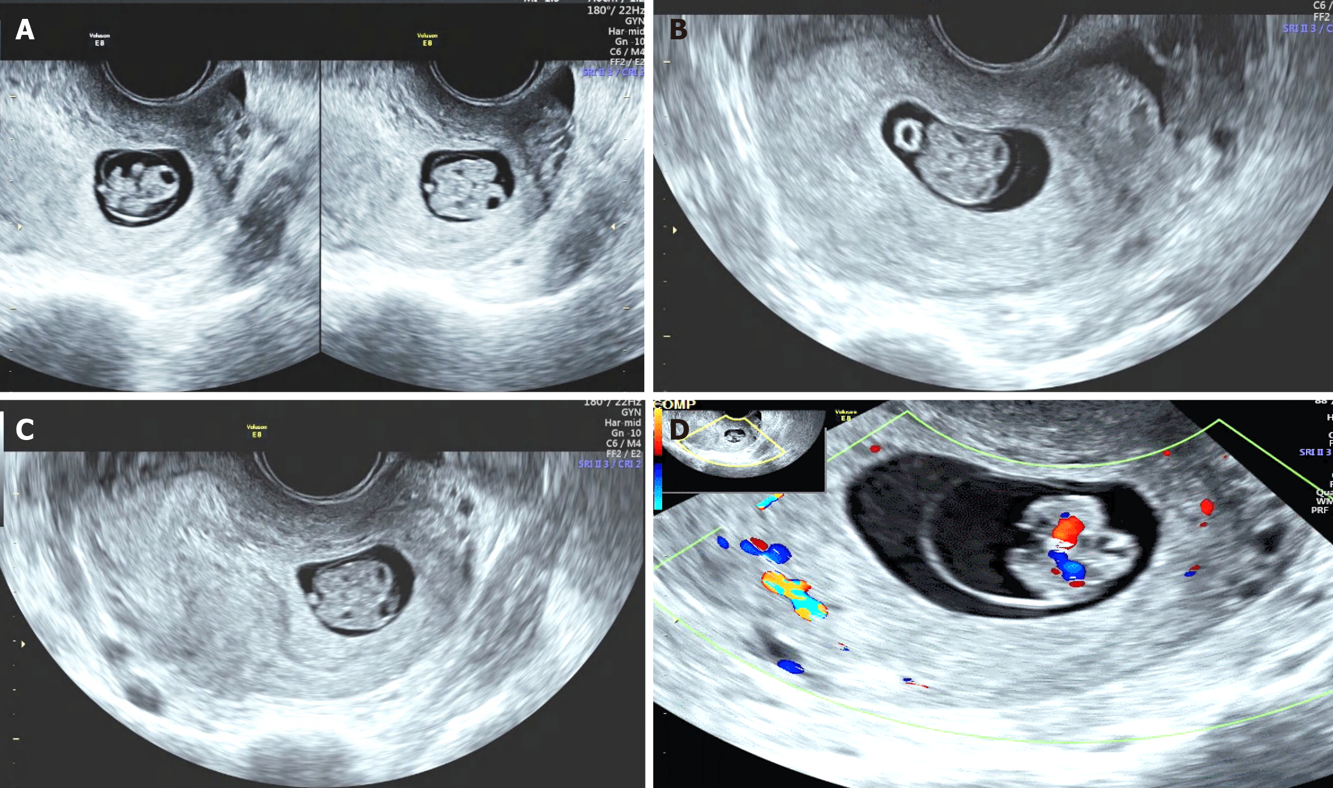 Twins Ultrasound 7 Weeks