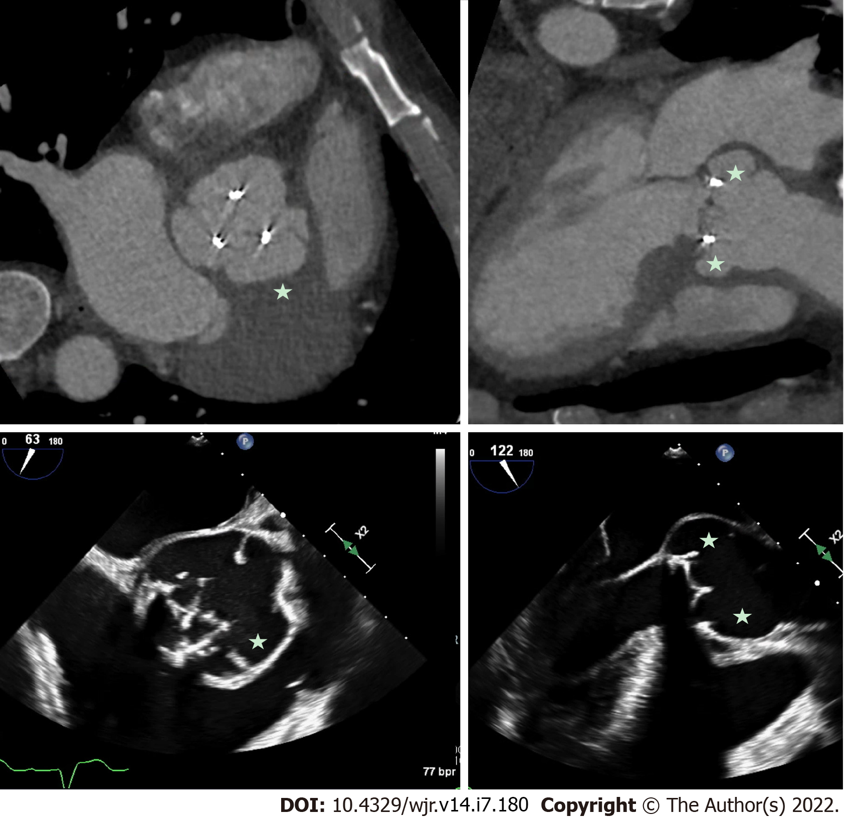 Infective Endocarditis Tee