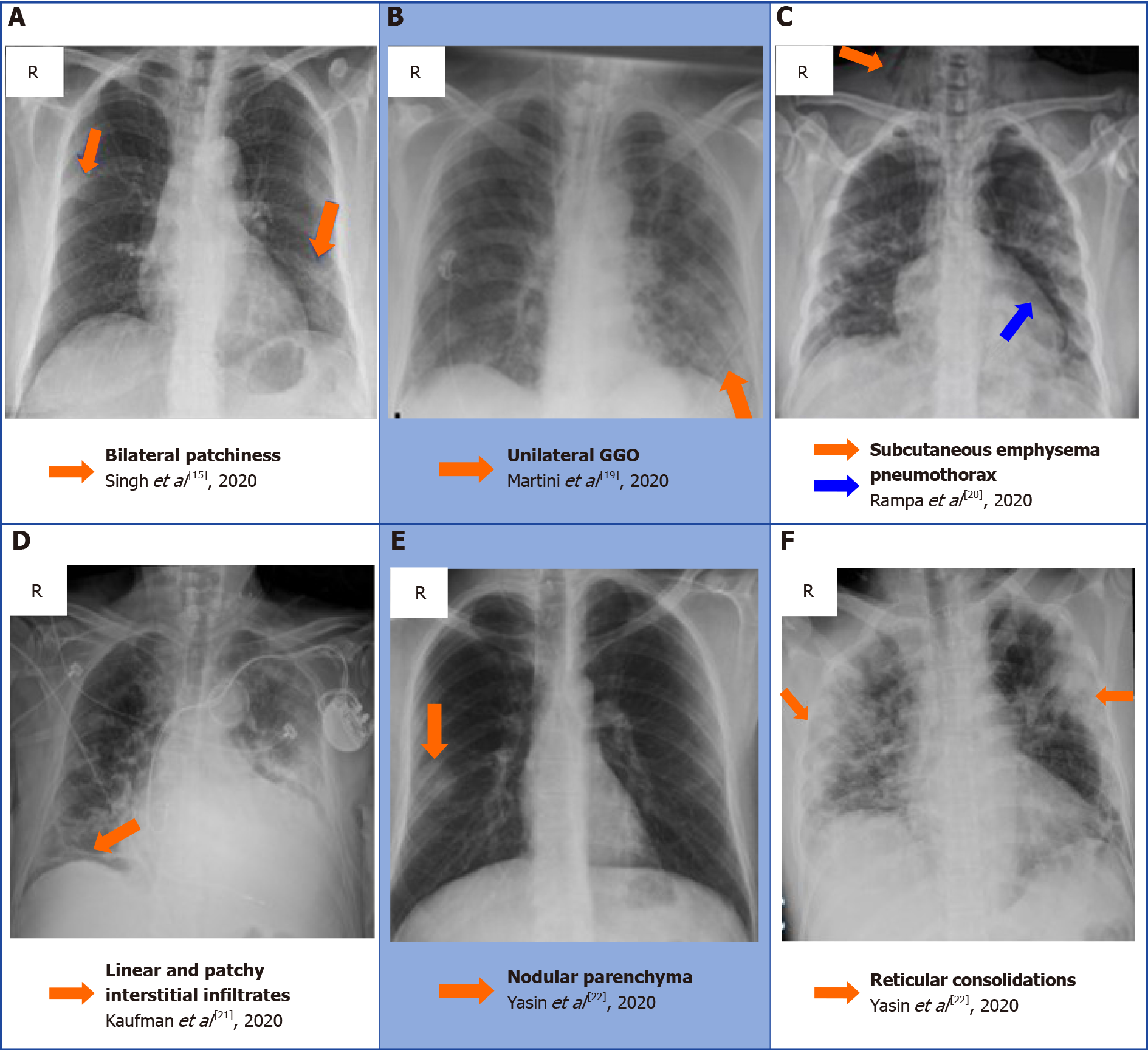 Chest X Ray Consolidation Vs Infiltrate