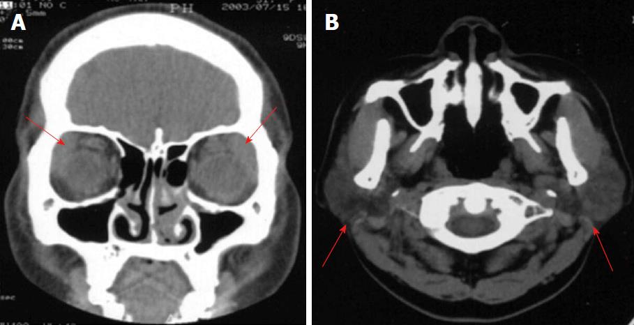 Highlighting the importance of early diagnosis in progressive multi ...