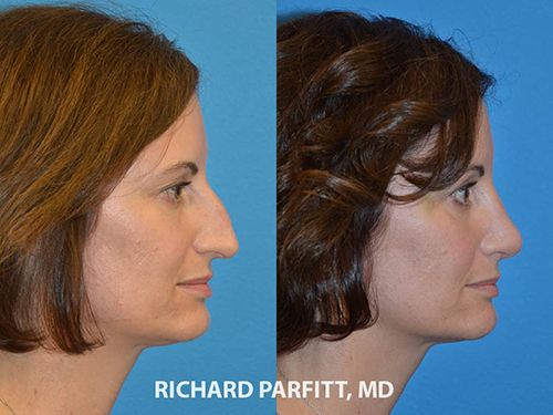 Rhinoplasty - Parfitt Facial Plastic Surgery Center