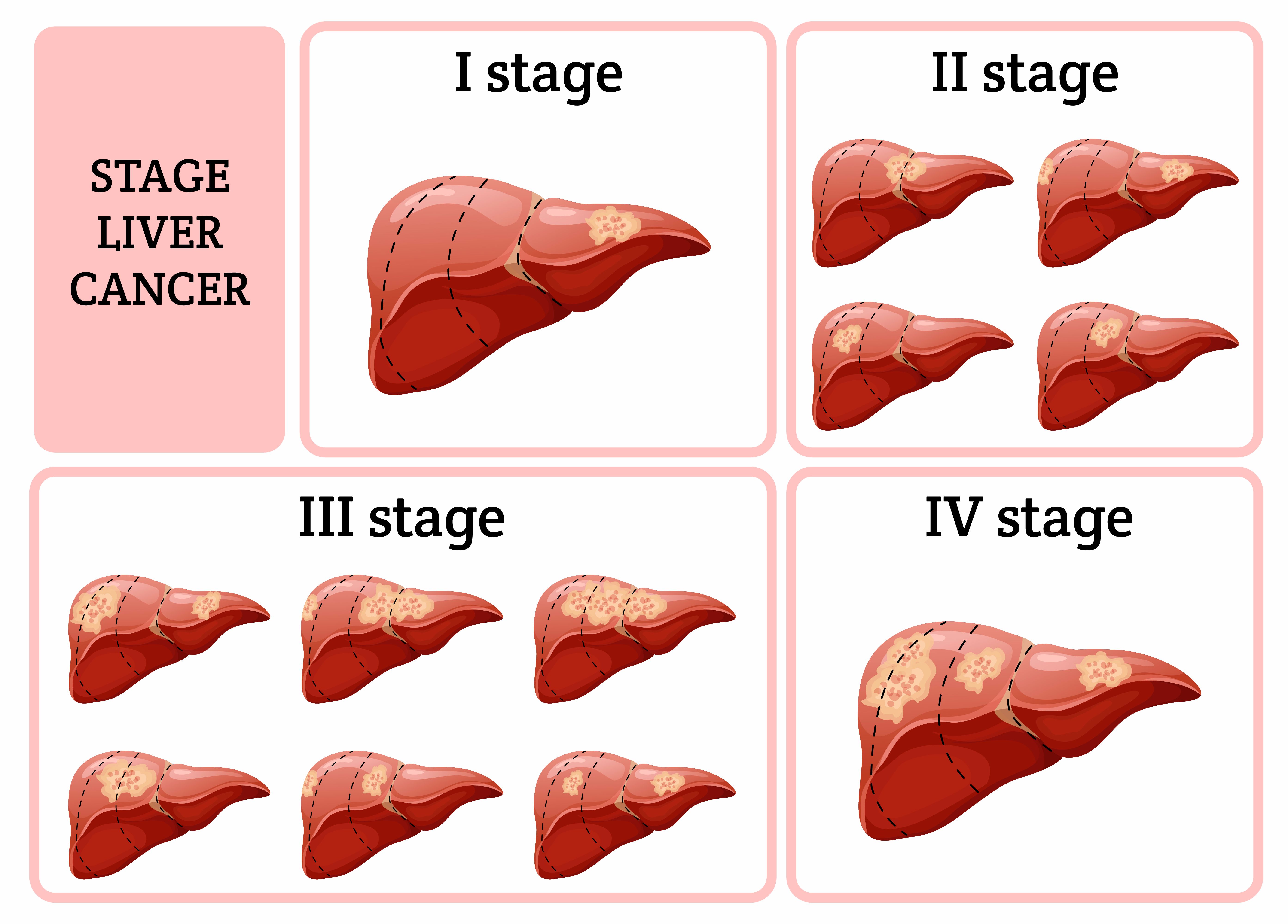 Liver Cancer Types And Stages