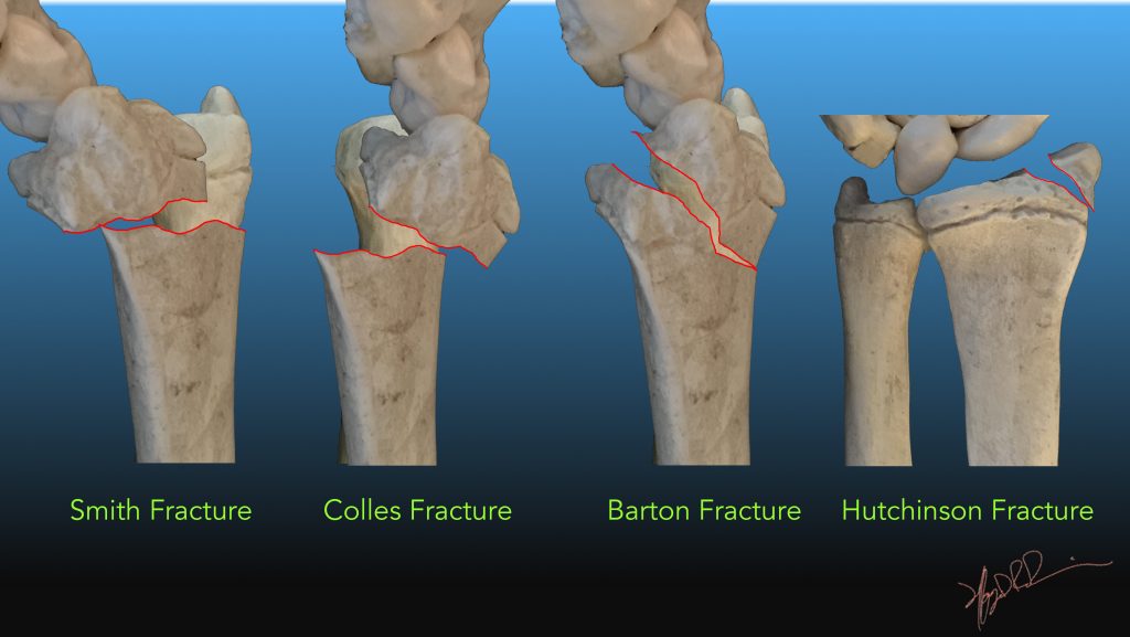 Different Types Of Fractures