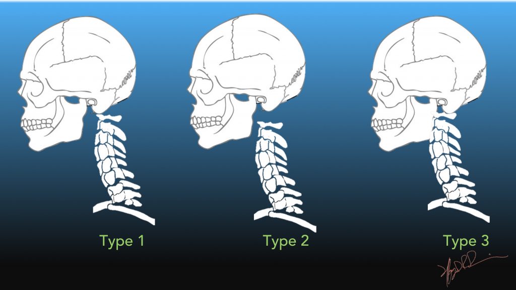 Atlanto Occipital Joint Xray