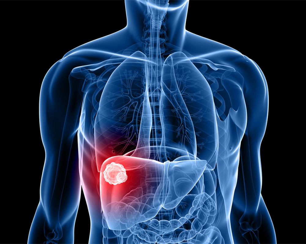 Liver Cancer Diagram