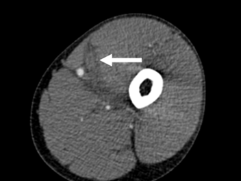 Pyomyositis in an Immunocompetent Intravenous Drug User