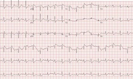 Successful Treatment of Massive Pulmonary Embolism in Pregnancy with Catheter-Directed Embolectomy