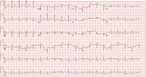 Successful Treatment of Massive Pulmonary Embolism in Pregnancy with Catheter-Directed Embolectomy