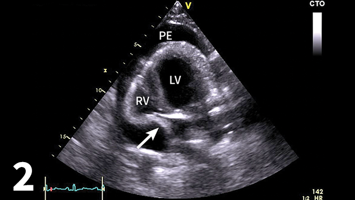 Canine Pleural Effusion