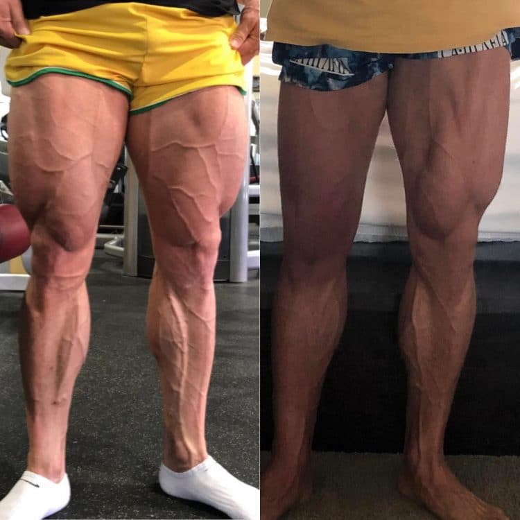 Calum Von Moger Before After Quad Injury