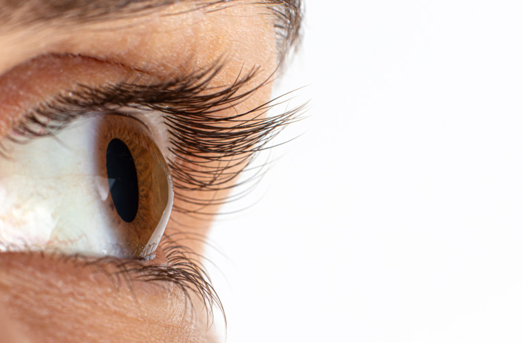 A close-up of an eye with keratoconus.