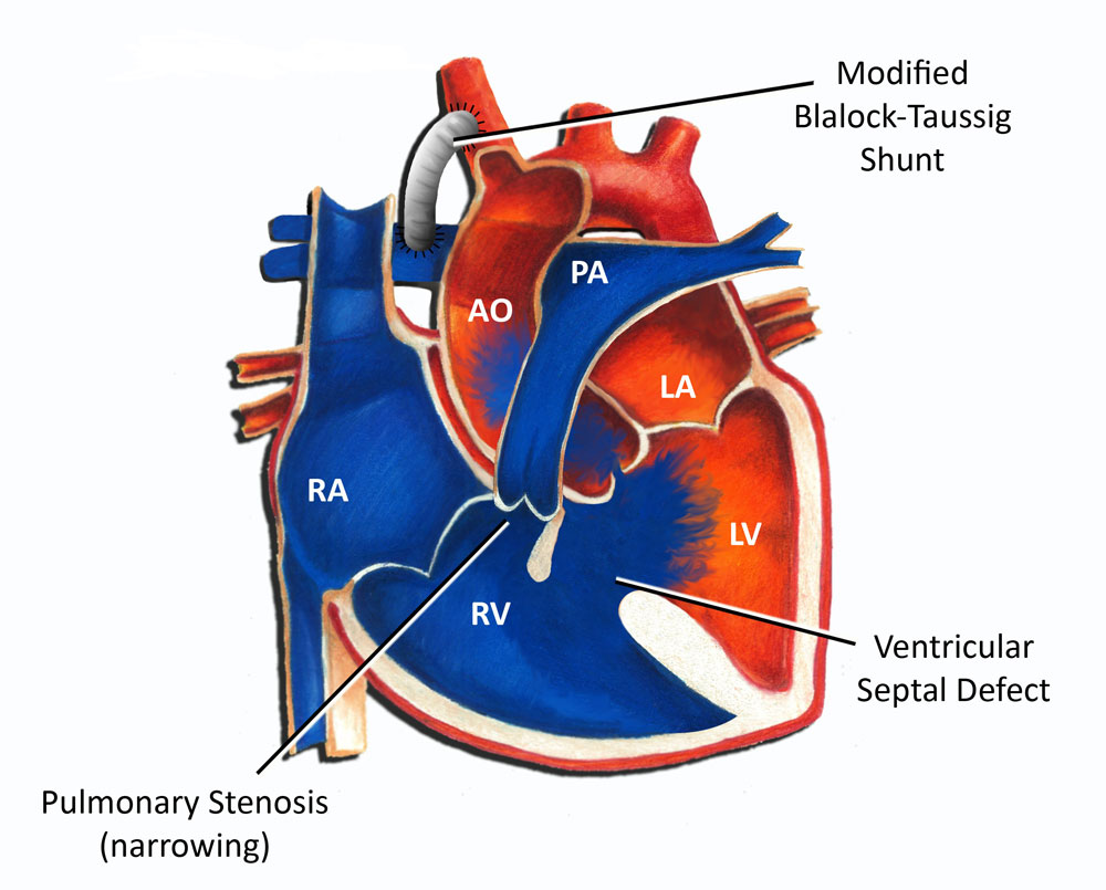 Tetralogy of Fallot (TOF) | Faculty of Medicine