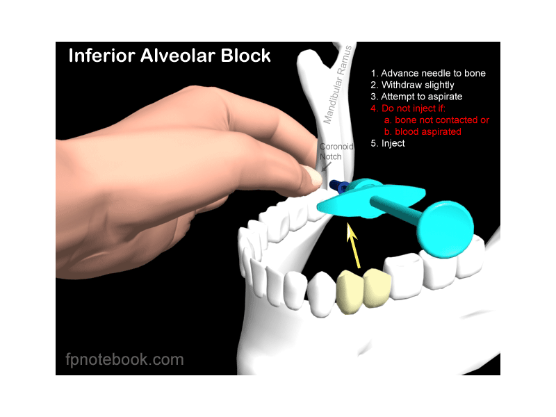 Inferior Alveolar Nerve Block Landmarks