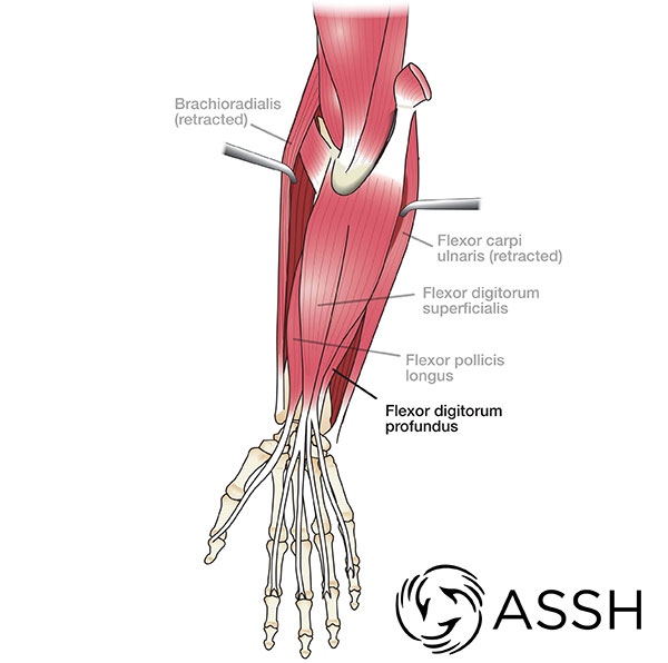 Common Flexor Tendon Muscles