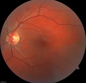 Macula and retinal conditions image - Gold Coast & Tweed Eye Doctors