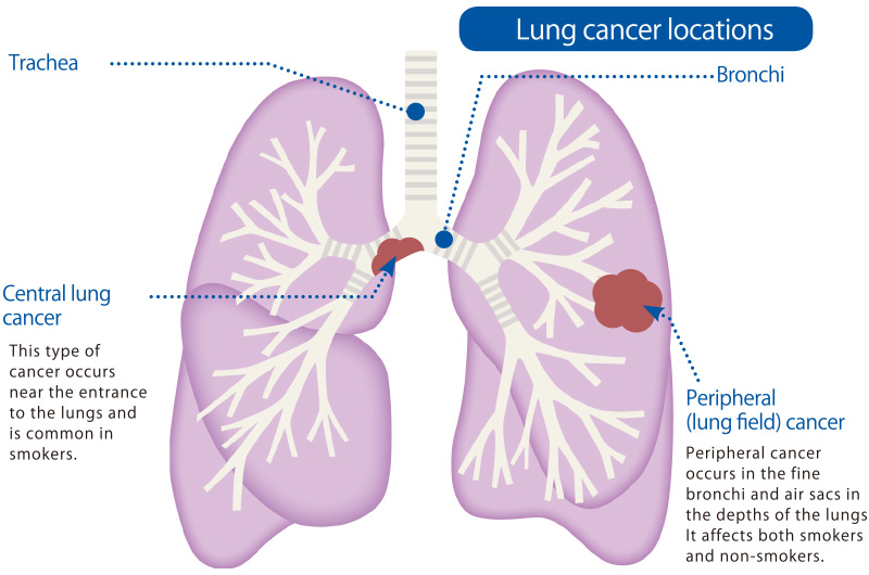 82. Lung tumors – greek.doctor