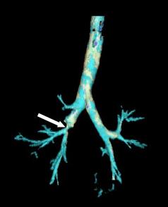 Bronchial stenosis CT.JPG