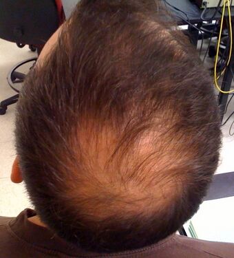 Alopecia.jpg