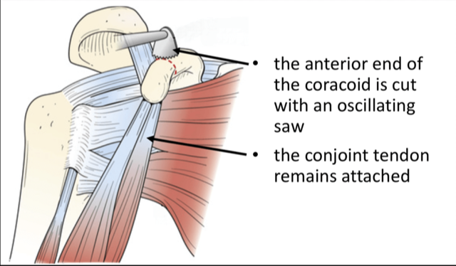 Conjoint Tendon Shoulder