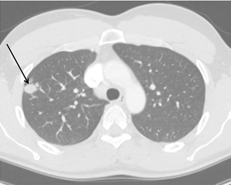 Pulmonary Nodule