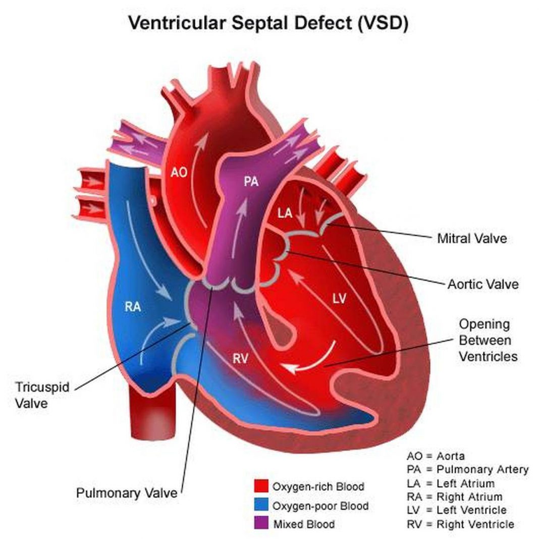 Pictures Of Cardiac Septum