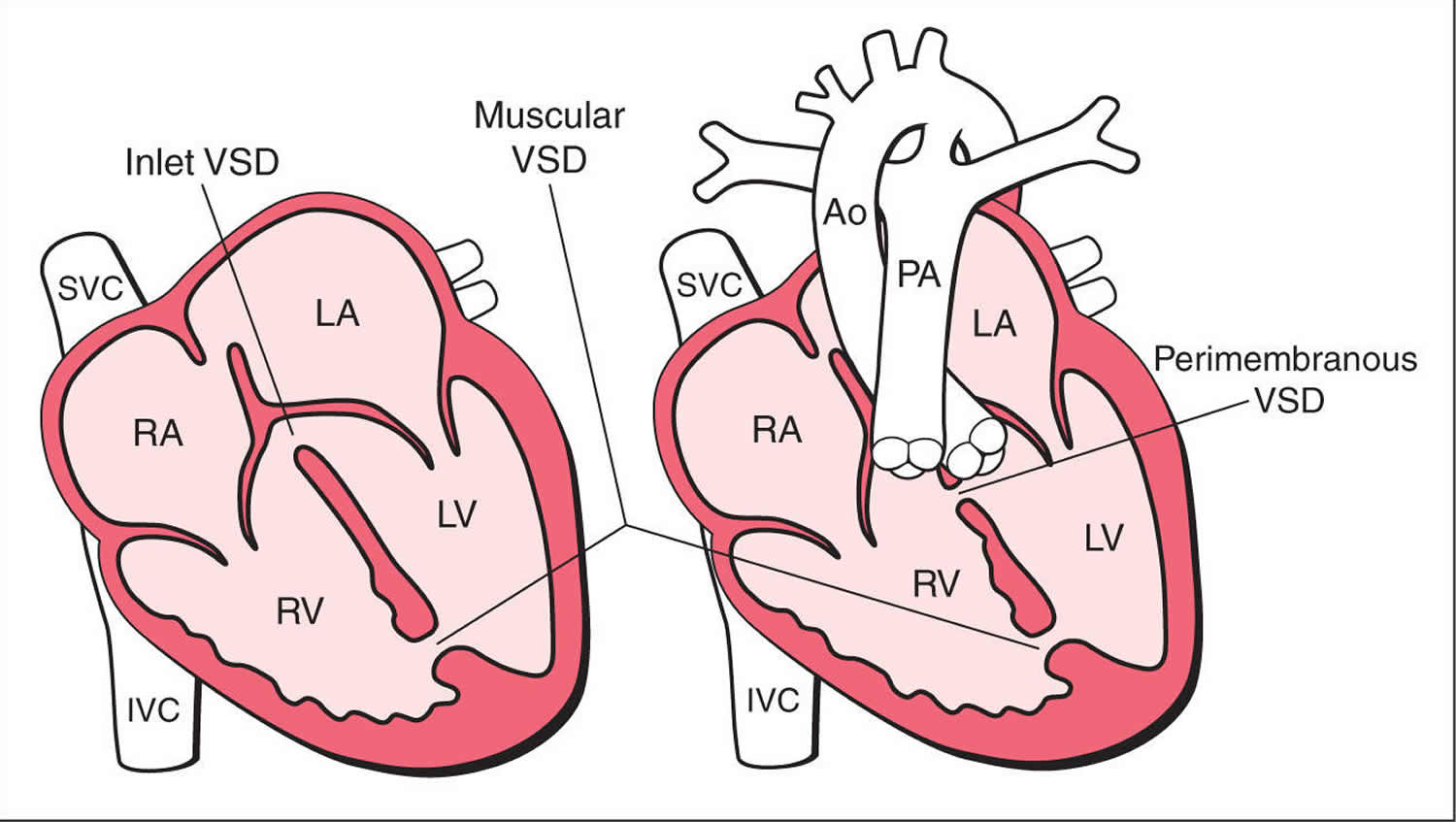 Vsd Types Ventricular Septal Defect Heart Defect Medi - vrogue.co