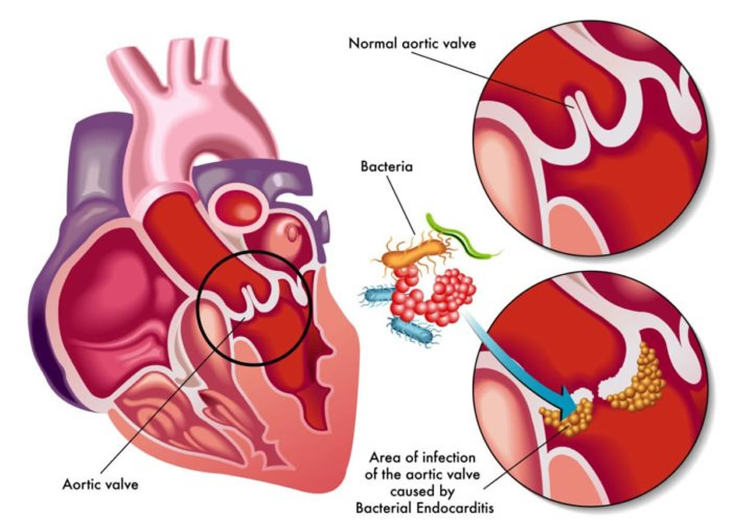 Vegetations Of Infective Endocarditis