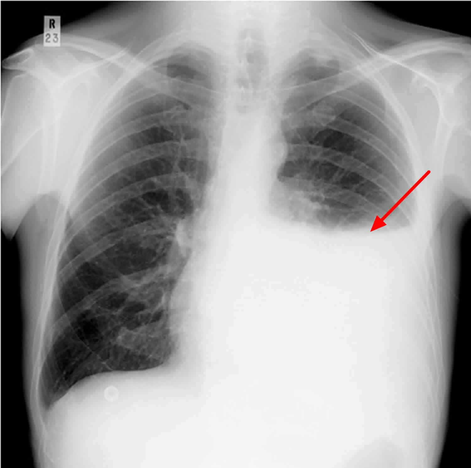 Chest Xray Posteroanterior View Showing Rightsided Pleural Effusion Images