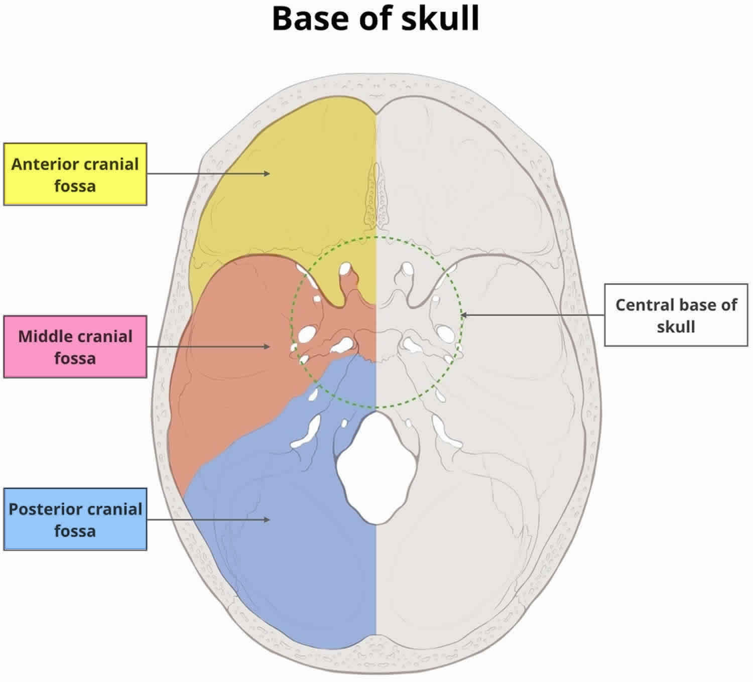 Bilateral Anteromedial Middle Cranial Fossa Defects C - vrogue.co