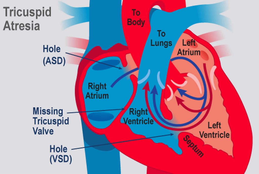 Tricuspid atresia causes, symptoms, diagnosis, treatment & prognosis