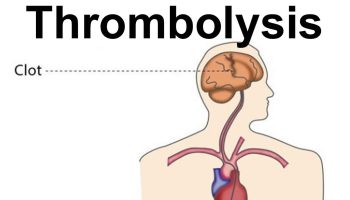 thrombolysis