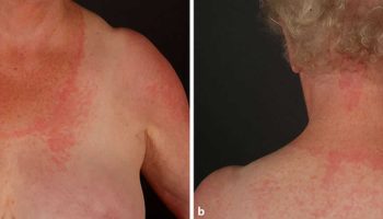 Photoallergic contact dermatitis