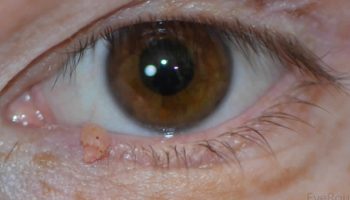 eyelid-papilloma