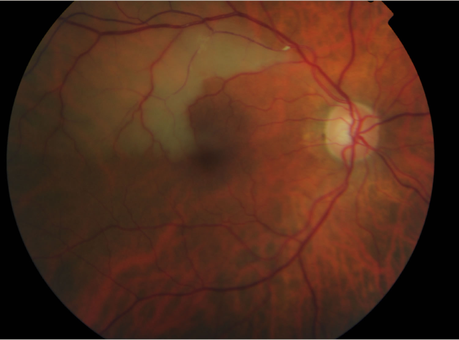 Retinal artery occlusion causes, symptoms, diagnosis, treatment & prognosis image.