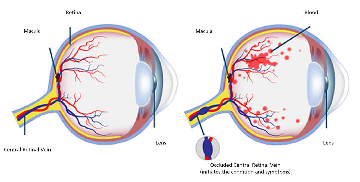 Retinal Artery