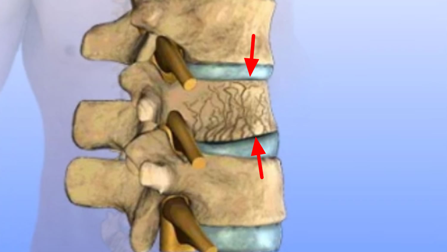 Compression fractures of the back as related to Bone Fracture - Pictures