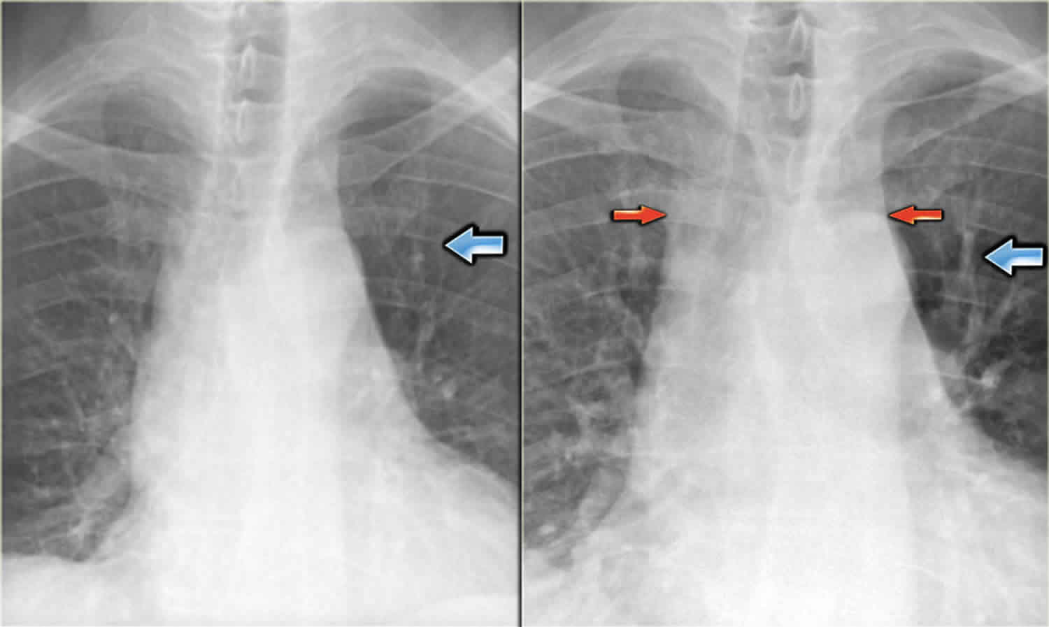 Vascular congestion definition & pulmonary vascular congestion