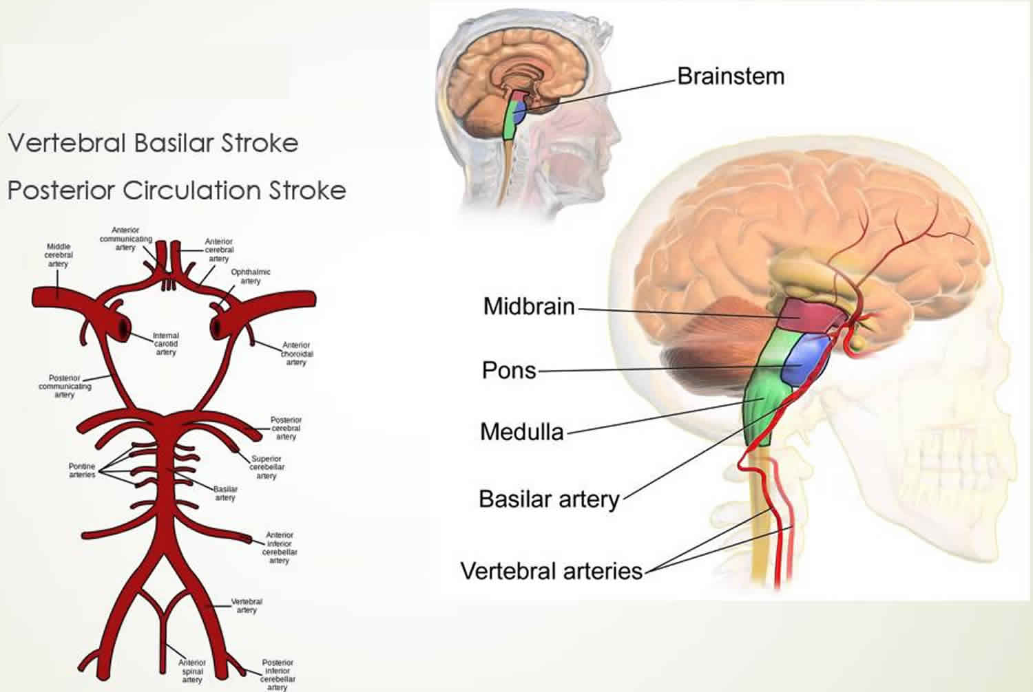 Wallenberg syndrome causes, symptoms, diagnosis, treatment & prognosis